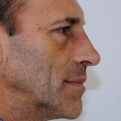 Rhinoplasty Before & After Patient #2237