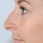 Rhinoplasty Before & After Patient #2239