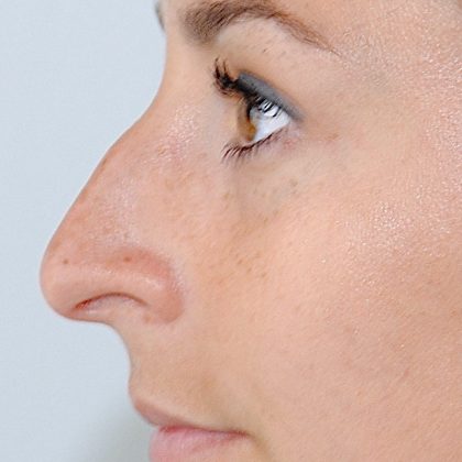 Rhinoplasty Before & After Patient #2239