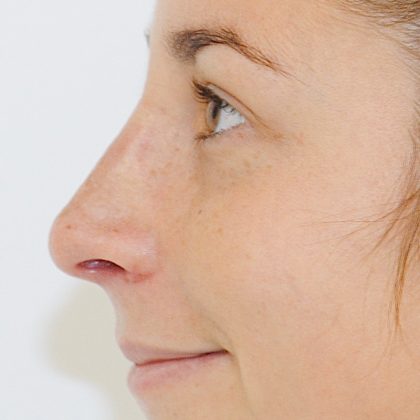 Rhinoplasty Before & After Patient #2239