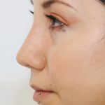Rhinoplasty Before & After Patient #2240