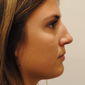 Rhinoplasty Before & After Patient #2242