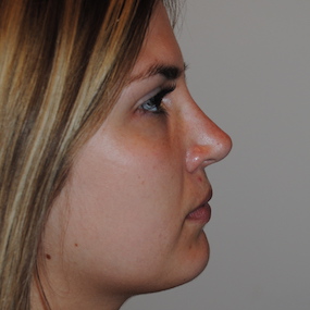 Rhinoplasty Before & After Patient #2242
