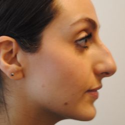 Rhinoplasty Before & After Patient #2244