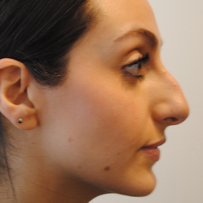 Rhinoplasty Before & After Patient #2244
