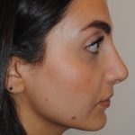Rhinoplasty Before & After Patient #2244
