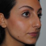 Rhinoplasty Before & After Patient #2244