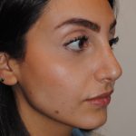 Rhinoplasty Before & After Patient #2244