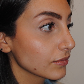 Rhinoplasty Before & After Patient #2244