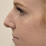 Rhinoplasty Before & After Patient #2246