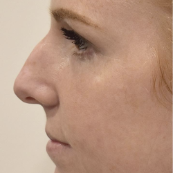 Rhinoplasty Before & After Patient #2246