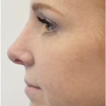 Rhinoplasty Before & After Patient #2246