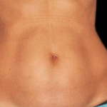 Laser Hair Removal Before & After Patient #2641