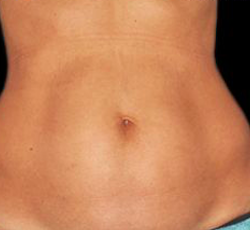 Laser Hair Removal Before & After Patient #2641