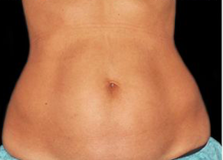 Laser Hair Removal Before & After Patient #2641