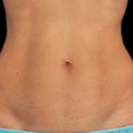 Laser Hair Removal Before & After Patient #2641
