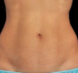 Laser Hair Removal Before & After Patient #2641