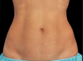 Laser Hair Removal Before & After Patient #2641