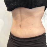 Tummy Tuck Before & After Patient #2890