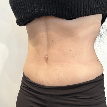 Tummy Tuck Before & After Patient #2890