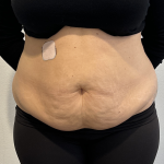 Tummy Tuck Before & After Patient #2890