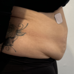 Tummy Tuck Before & After Patient #2890