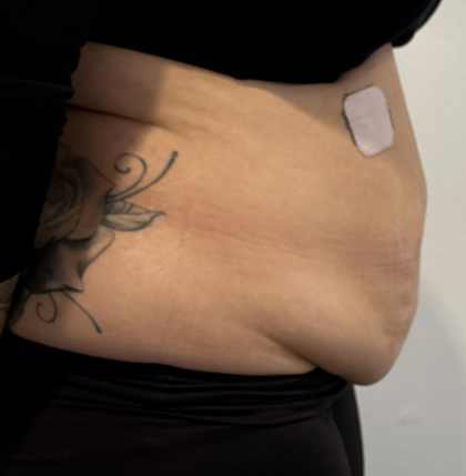 Tummy Tuck Before & After Patient #2890