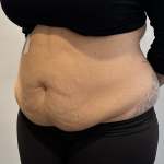 Tummy Tuck Before & After Patient #2890