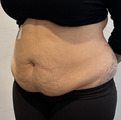 Tummy Tuck Before & After Patient #2890