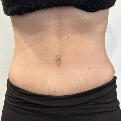 Tummy Tuck Before & After Patient #2890