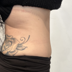 Tummy Tuck Before & After Patient #2890