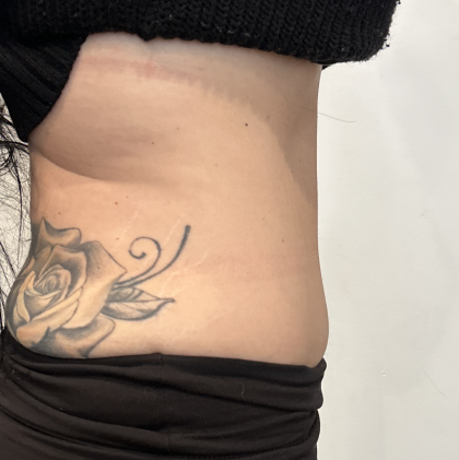 Tummy Tuck Before & After Patient #2890